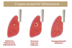 Проявления очагового туберкулеза