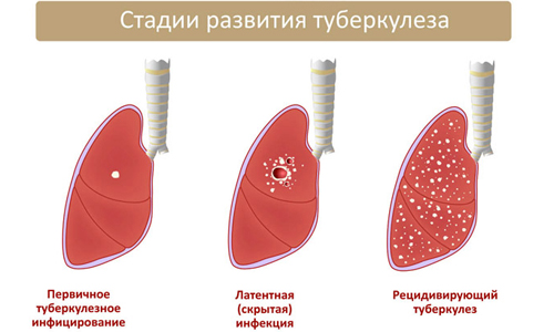 Стадии развития туберкулеза