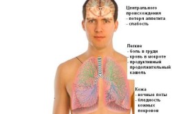 Основные признаки туберкулеза 