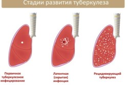 Стадии развития туберкулеза
