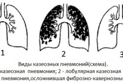 Виды казеозных пневмоний