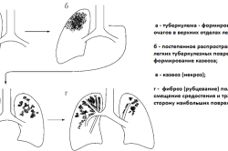 Этапы развития вторичного туберкулеза