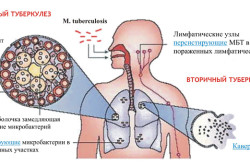 Механизм возникновения и развития туберкулеза