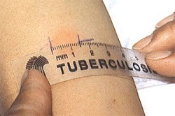 Результаты тестов на туберкулиновую пробу