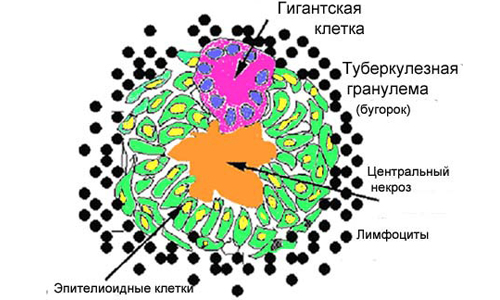 Схема туберкулезной гранулемы