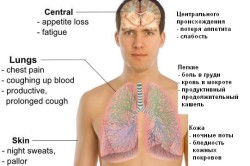 Симптомы туберкулеза