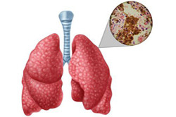 Туберкулез открытая форма 11