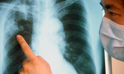 Туберкулез на рентгене