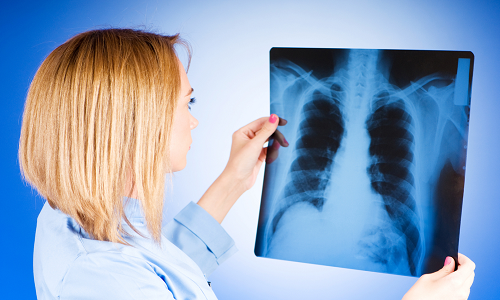 Рентгеновский снимок легких для выявления туберкулеза на ранней стадии 